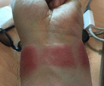 苹果手表灼伤女子手腕 被告知“肯定戴错了”