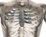 西班牙患者植入全球最复杂3D打印金属胸骨