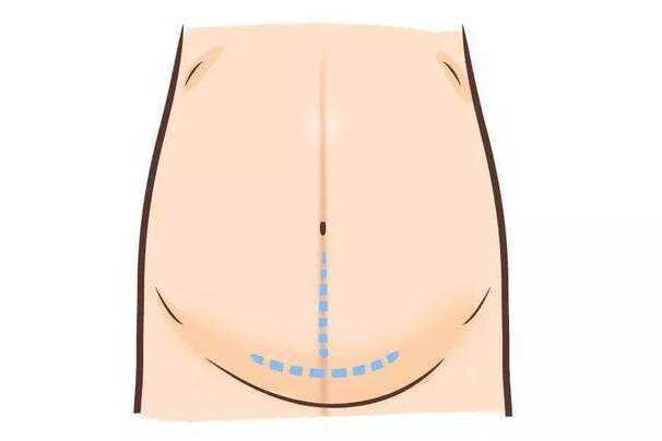 顺产受罪少吗？ ​