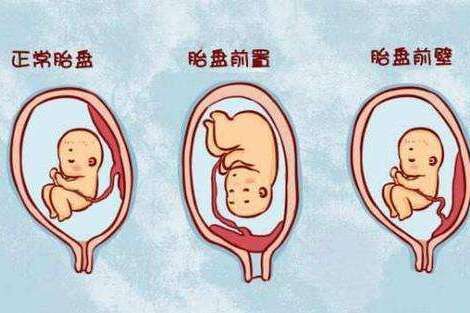 胎盘低置会长上去吗？
