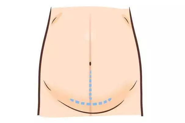 剖腹产切口，是露还是包？