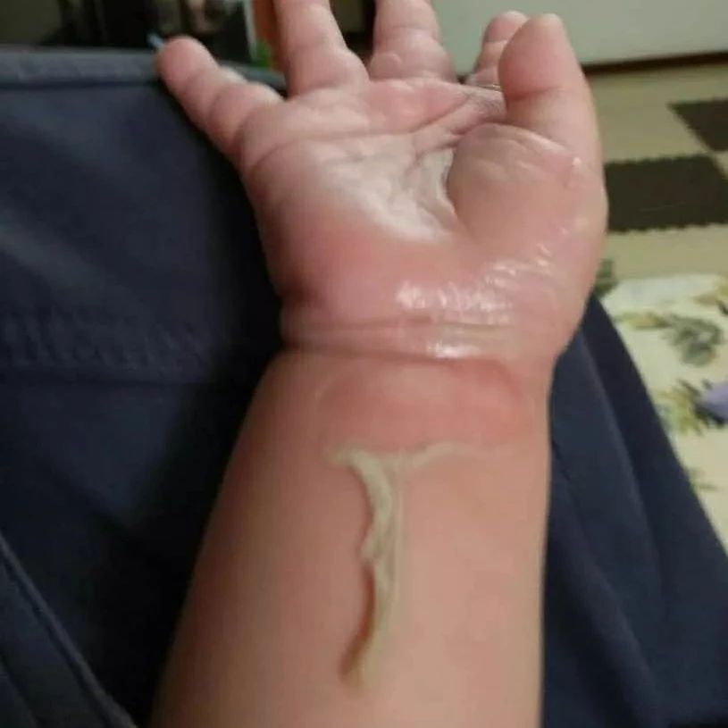 孩子烫伤后因家长这个愚蠢的做法进了ICU！今天这篇家长再忙也一定要看！