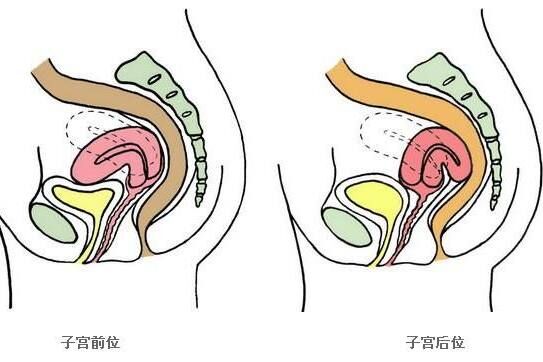子宫后位难怀孕还容易流产？