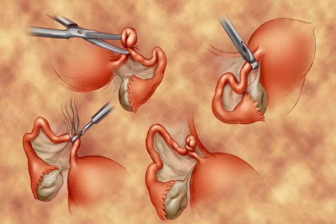 结扎就是让卵子和精子不相见