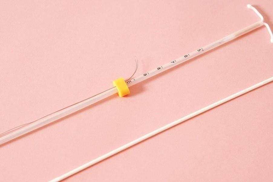 多囊孕妈与众不同？取出曼月乐环可以怀孕？