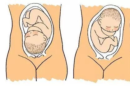 胎位不正可以做操吗？带环的宝宝可以留下来吗？