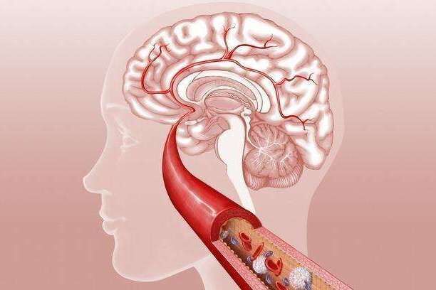 隐性中风让老人痴呆风险加倍！这些症状是隐性中风的前兆