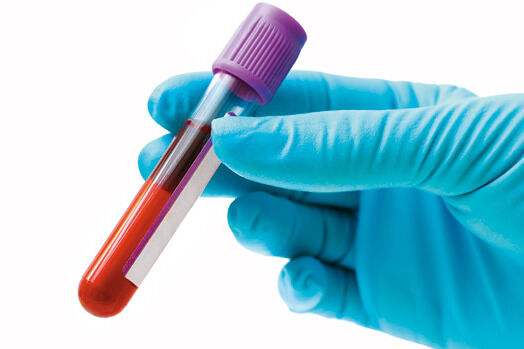 搜狐科学 |&nbsp;抽血也能查老年痴呆了！美国科学家发明的这种方法准确率高达94%