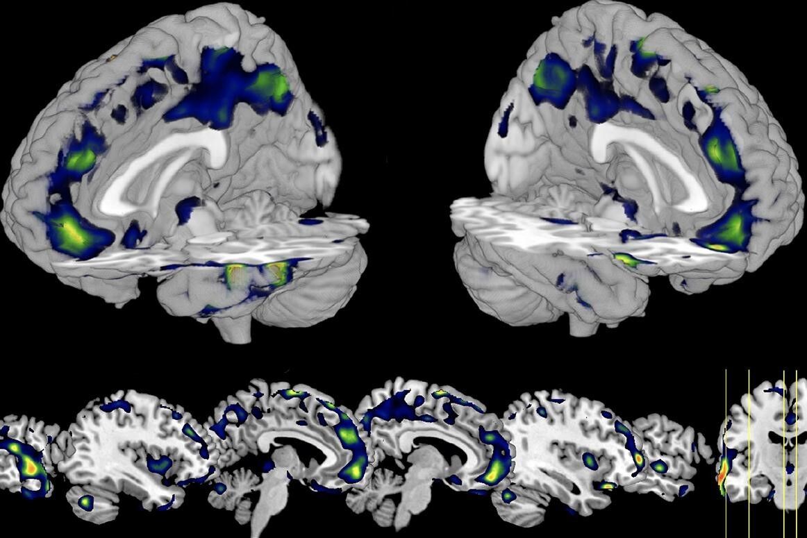扫描大脑预测犯罪？科学家发现杀人犯脑部的灰质较少