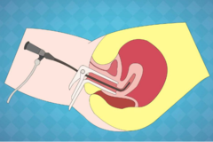 刮宫一个月后又怀孕了，有什么危害？