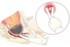 宫口开几指可以打无痛分娩？怕痛的准妈妈，不妨早了解