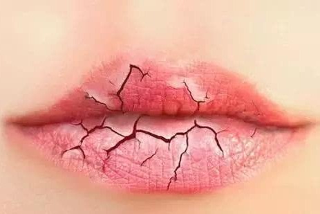 嘴唇干裂易脱皮？不用怕！最关键是做到这一点