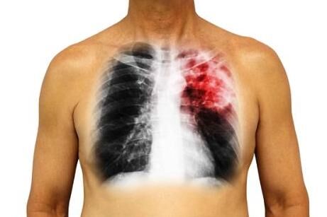 胸痛，呼吸不畅，医生：有这5种不易察觉的征兆，怕是离肺癌不远了