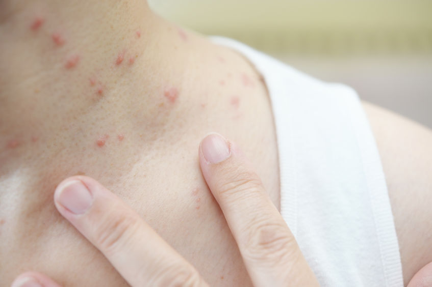 艾滋&ldquo;携带者&rdquo;约125万！若脖子出现这迹象， 是否需要做血测？