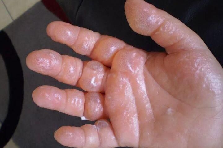 一碰就三级烧伤？这种来自欧洲的&ldquo;毒草&rdquo;，有可能就在你身边