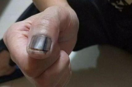 身体有癌，指甲先知？提醒：若指甲有这个表现，警惕这种癌症已到来