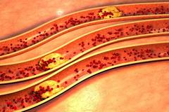 &ldquo;我才35岁就要做支架？&rdquo;你虽然年轻，但是血管已经70岁了