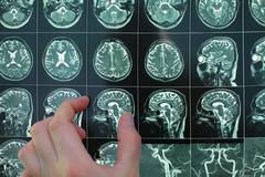 发现&ldquo;腔梗&rdquo;后怎么办？腔隙性脑梗，是什么原因引的呢？