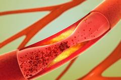 听说血脂出现问题，人的腿部会有异常表现，具体有什么呢？