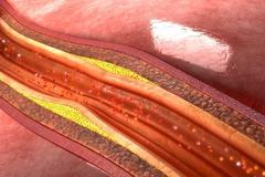 粥样硬化是血变成&ldquo;粥&rdquo;么？轻度狭窄的血管，吃药了还能恢复么？