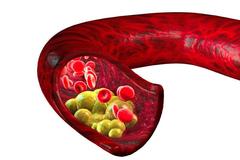 动脉的&ldquo;钙化&rdquo;与&ldquo;硬化&rdquo;一样么？哪种更严重，要怎么办呢？