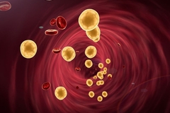 动脉粥样硬化，真的就是“血液粘稠如粥”吗？应该怎么办呢