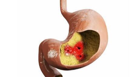 频繁打嗝要当心，可能是胃部炎症发出的预警，三种食物预防胃炎