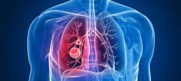 辽宁新增12例新型冠状病毒感染的肺炎确诊病例 累计确诊60例