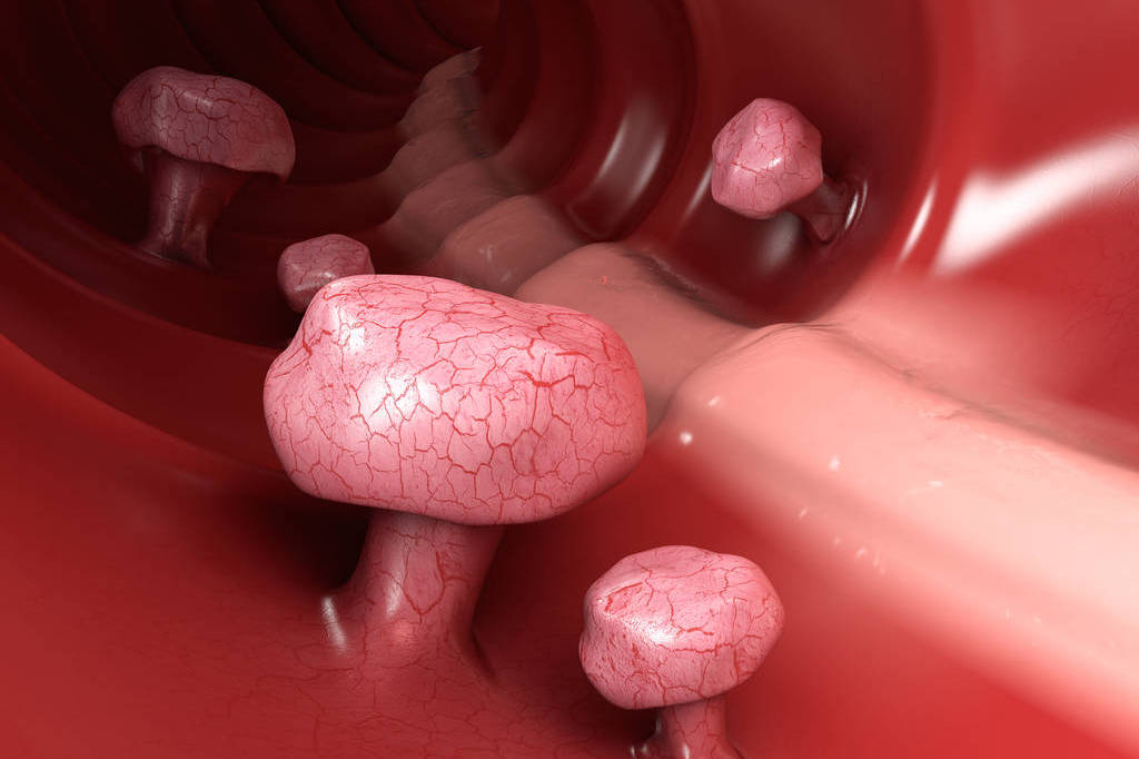 癌症是拖出来的，医生忠告，身体出现三种小病，最好及时治疗