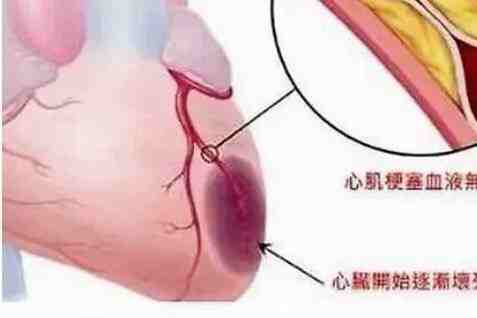 心梗，通常会发出的信号