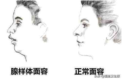 父母高颜值，孩子却越长越丑？先别往别处想，这可能是病