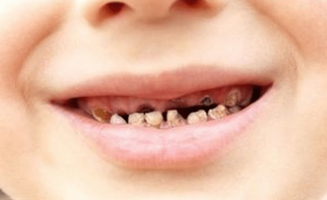 造成2岁孩子“小黑牙”的，不是糖果吃多了，而是父母的坏习惯